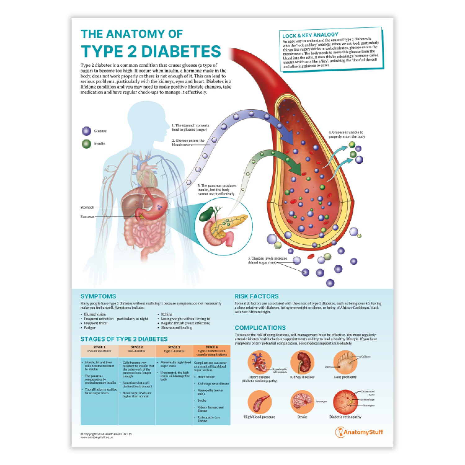 The Anatomy of Type 2 Diabetes Chart / Poster