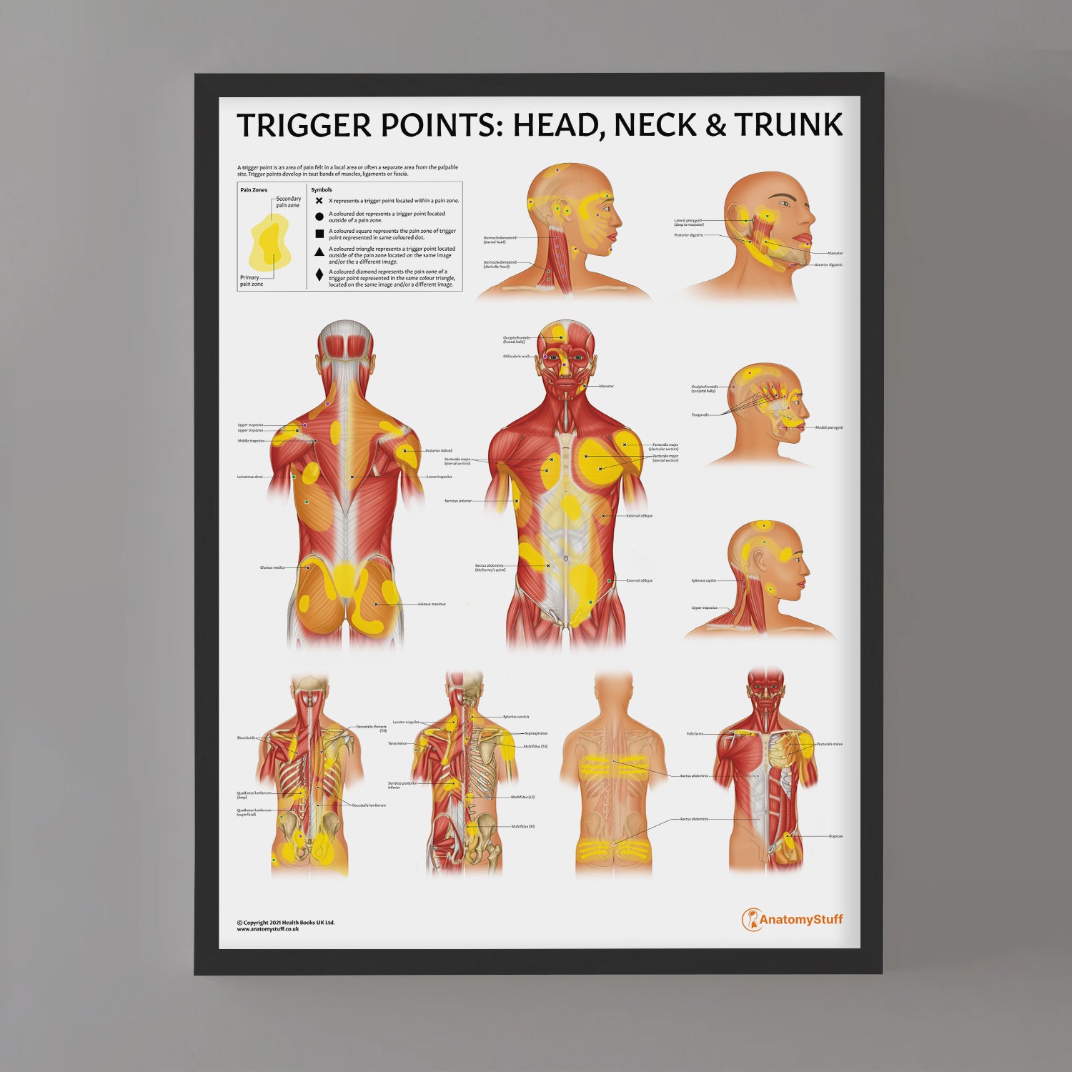 Trigger Points: Head, Neck & Trunk Chart / Poster