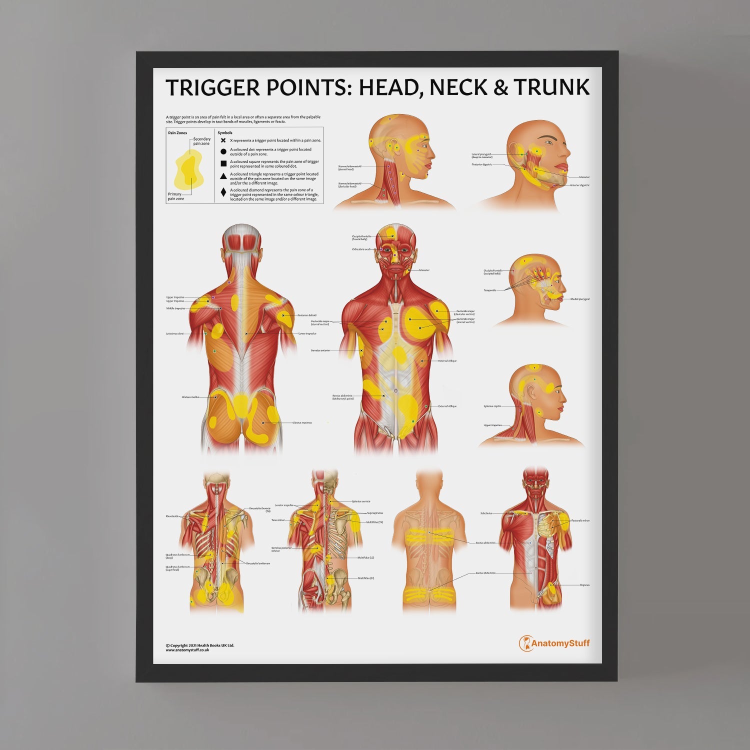Trigger Points: Head, Neck & Trunk Chart / Poster