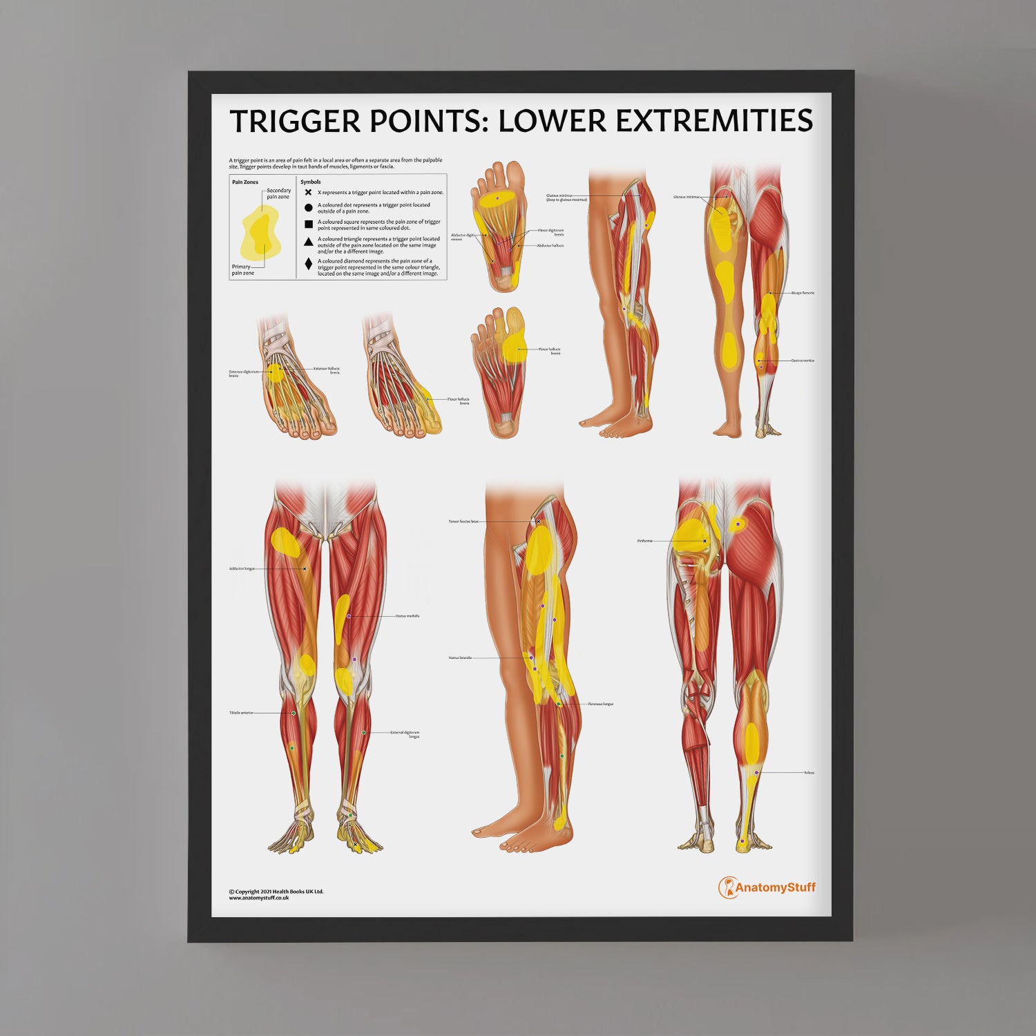 Trigger Points: Lower Extremities Chart / Poster