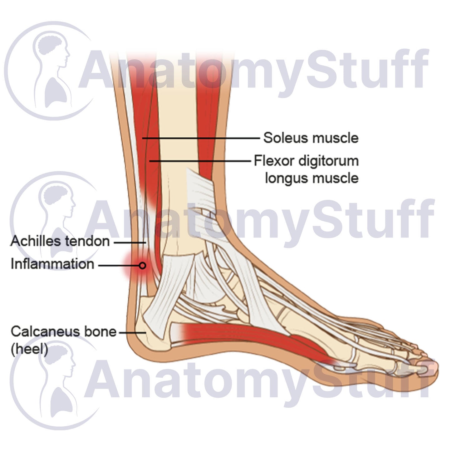 Achilles Tendinopathy Illustration