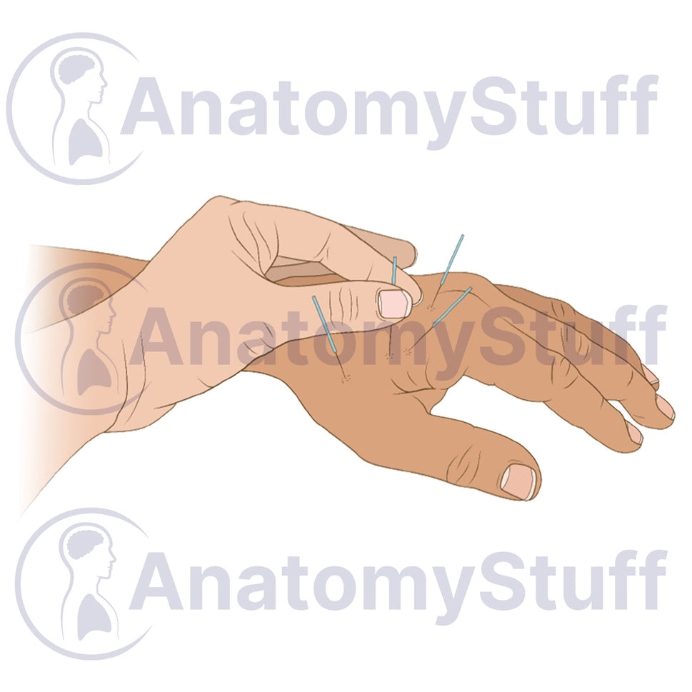 Hand Acupuncture Illustration