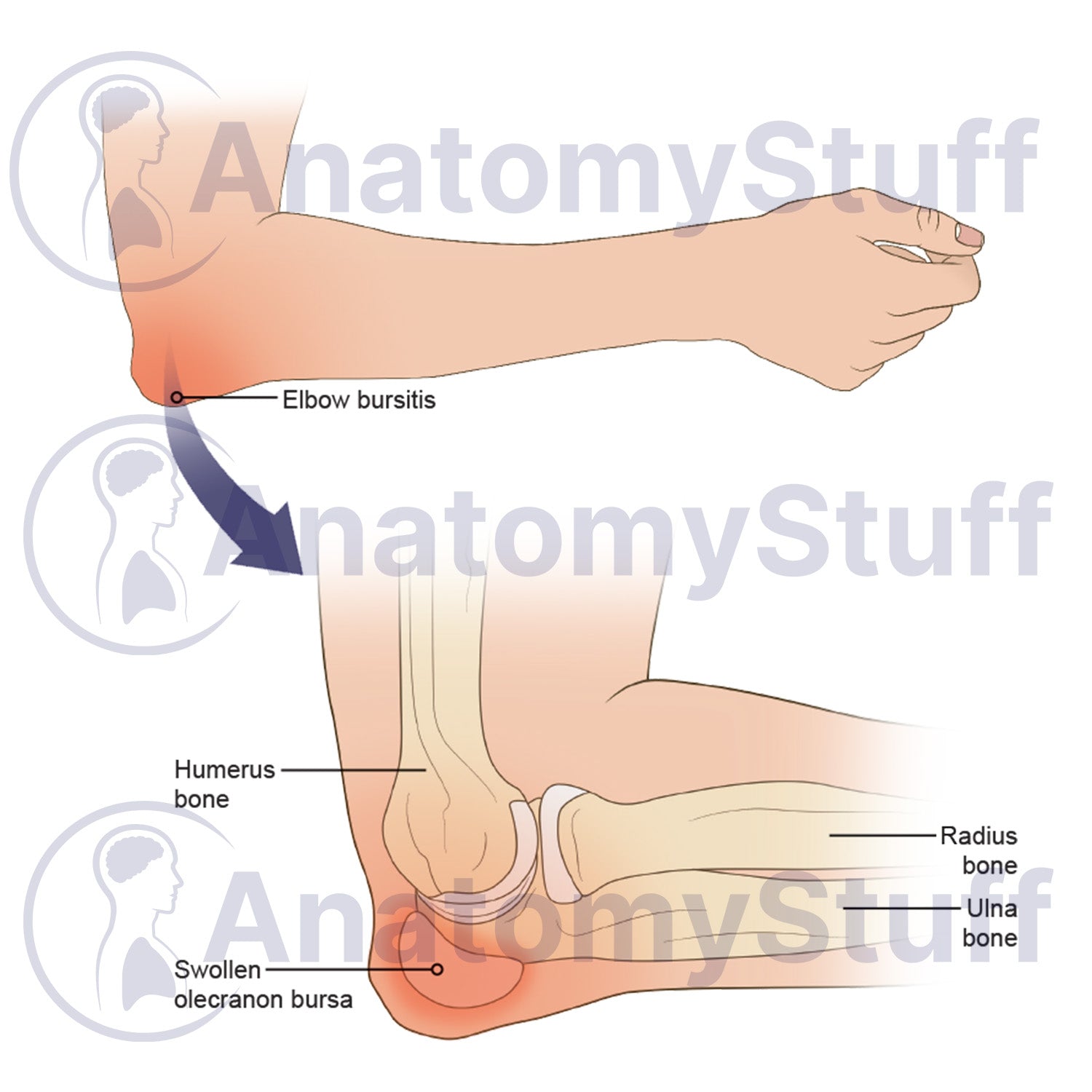 Elbow Bursitis Illustration