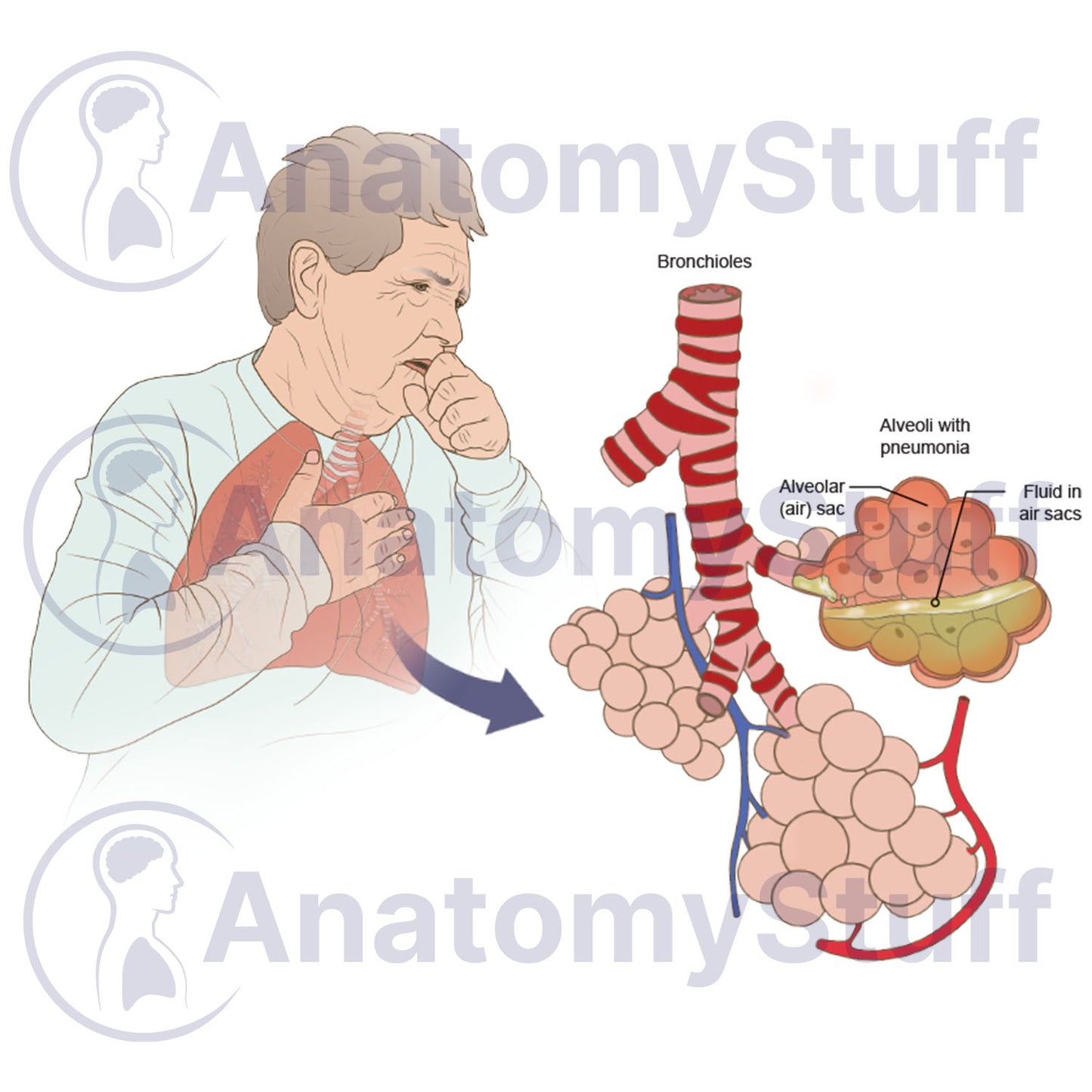 Pneumonia Illustration