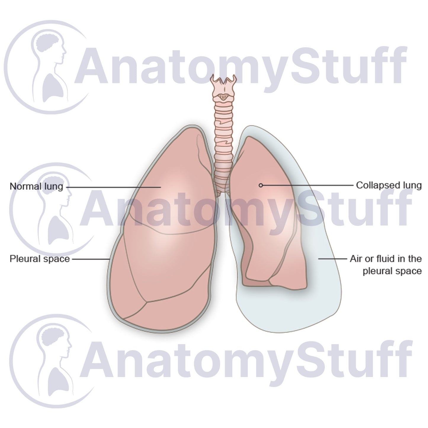 Pneumothorax Illustration