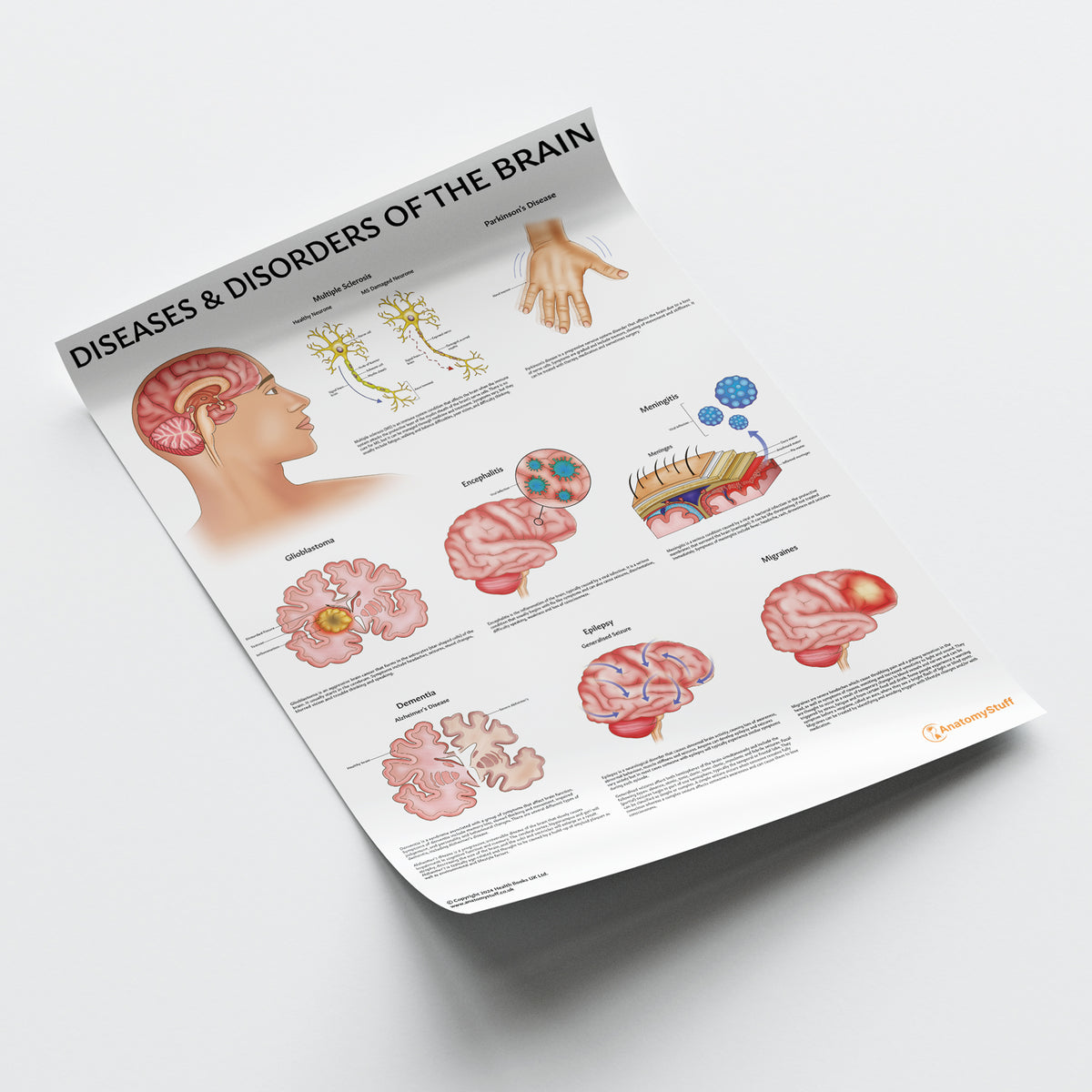 Brain Disease Anatomy Poster | Common Brain Disorders Chart – AnatomyStuff