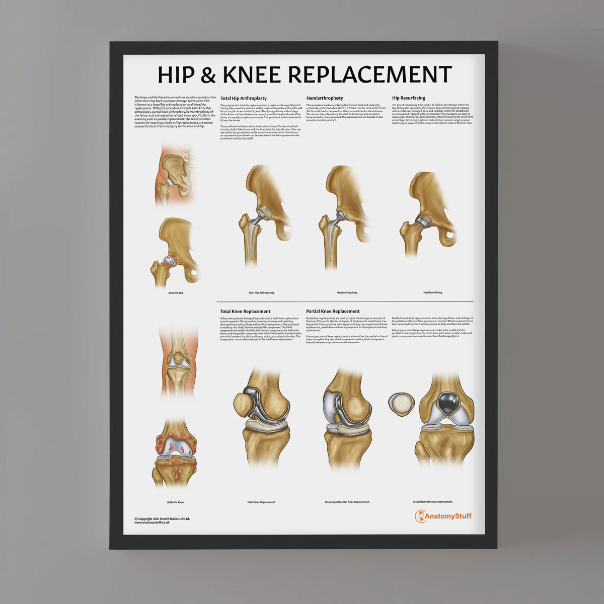 Hip Basicplus Chart.pdf Hip and Knee Replacement Poster | Joint Surgery Anatomy Chart ...