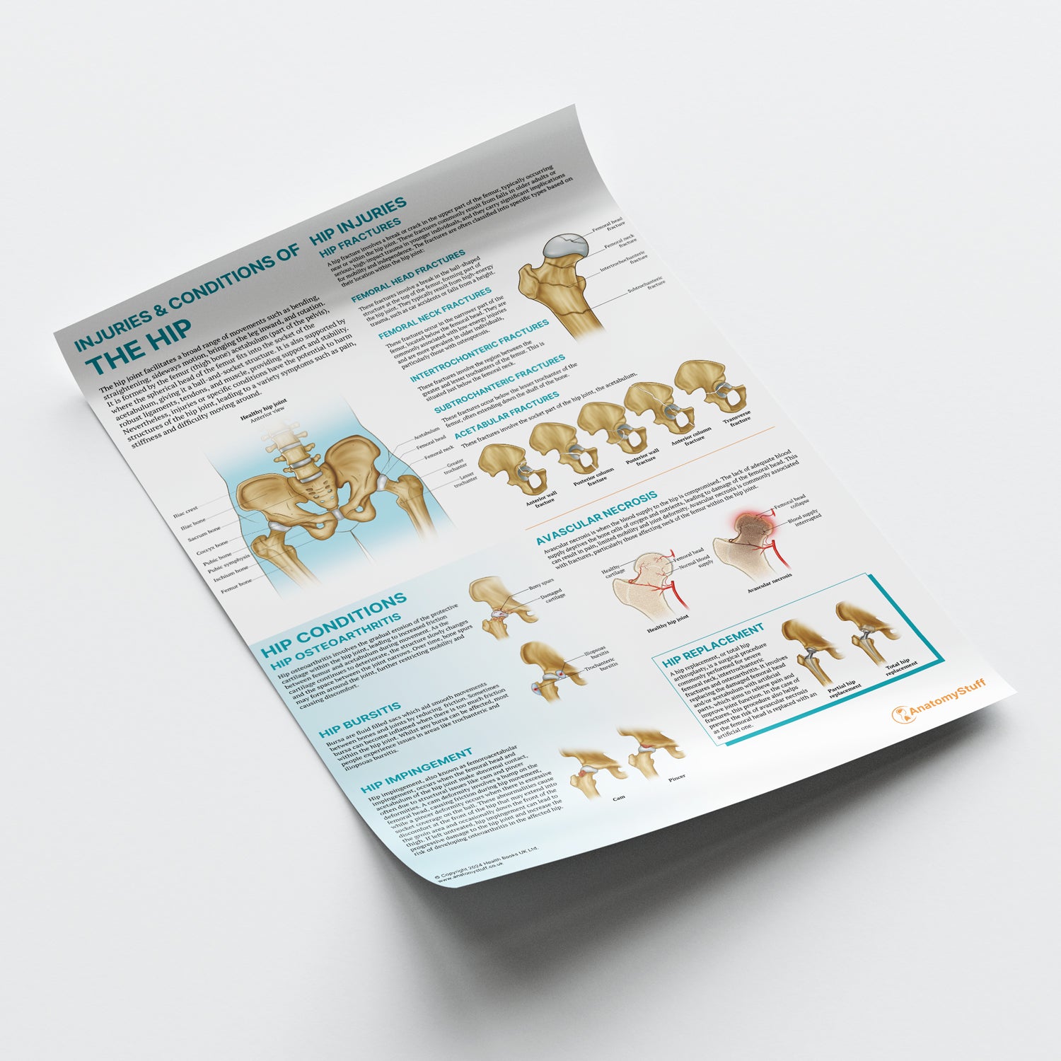 Anatomy of Hip Injuries & Conditions Poster | Hip Joint Chart ...