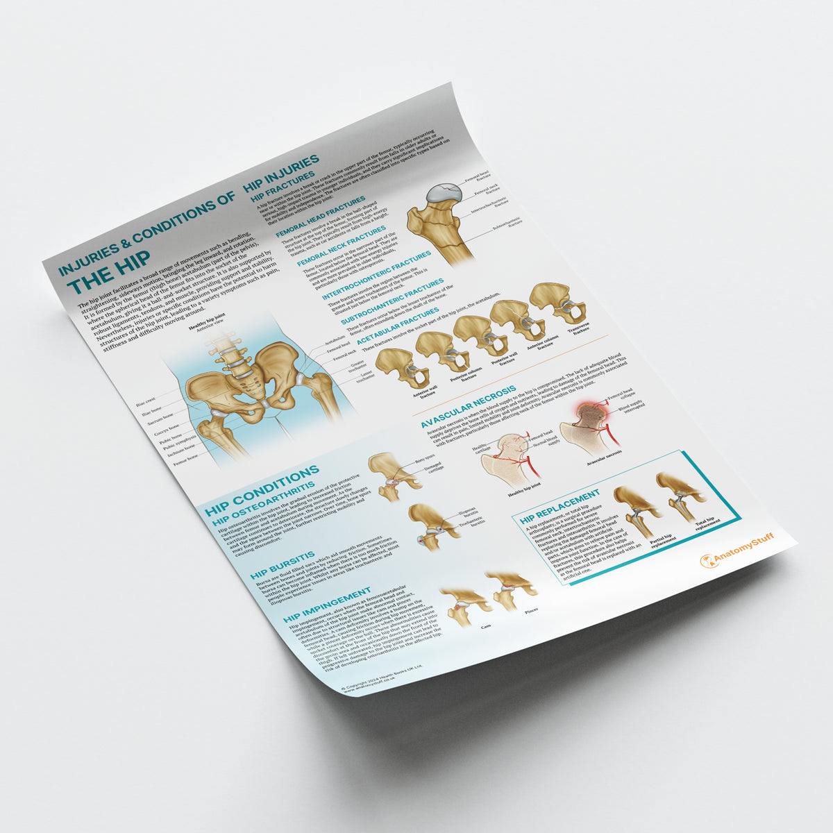 Hip Basicplus Chart.pdf Anatomy of Hip Injuries & Conditions Poster | Hip Joint Chart ...
