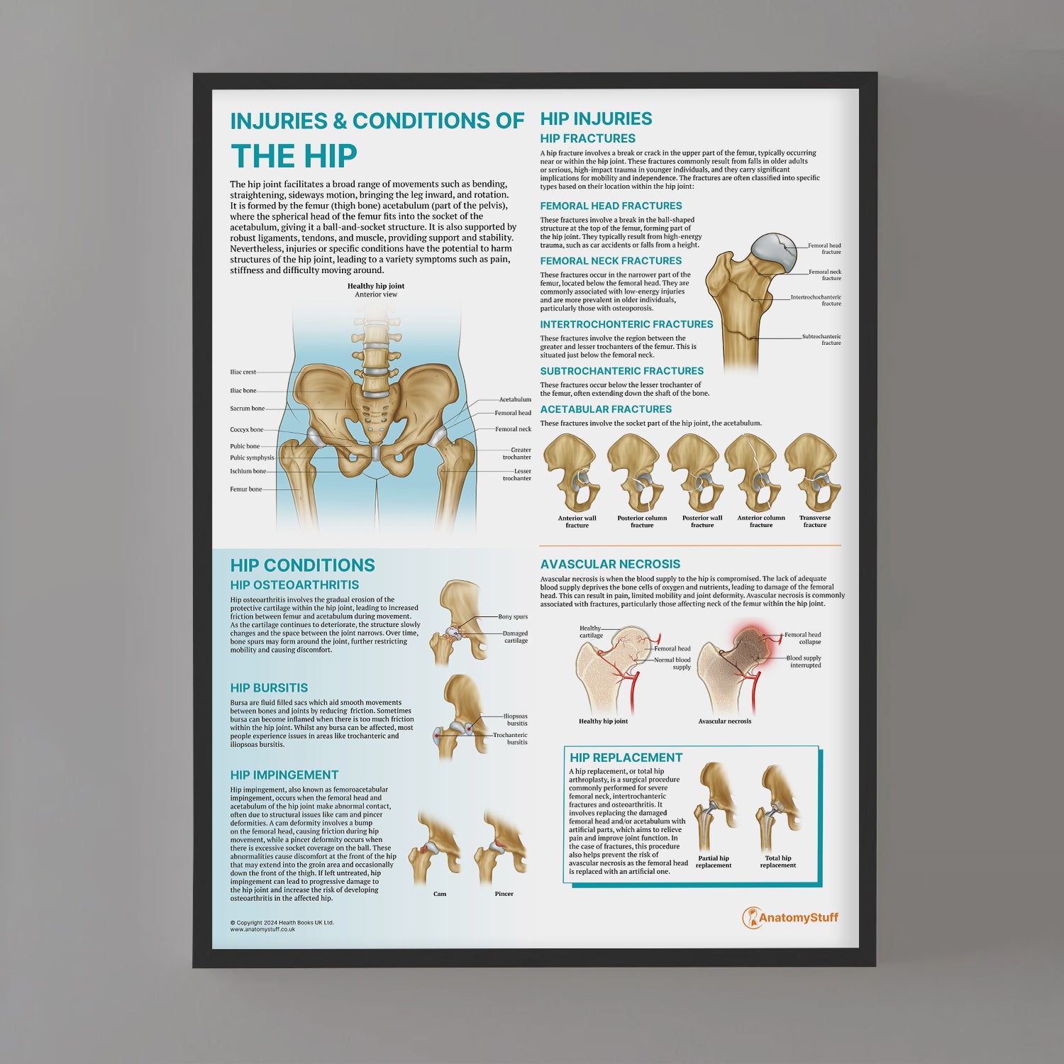 Anatomy of Hip Injuries & Conditions Poster | Hip Joint Chart ...