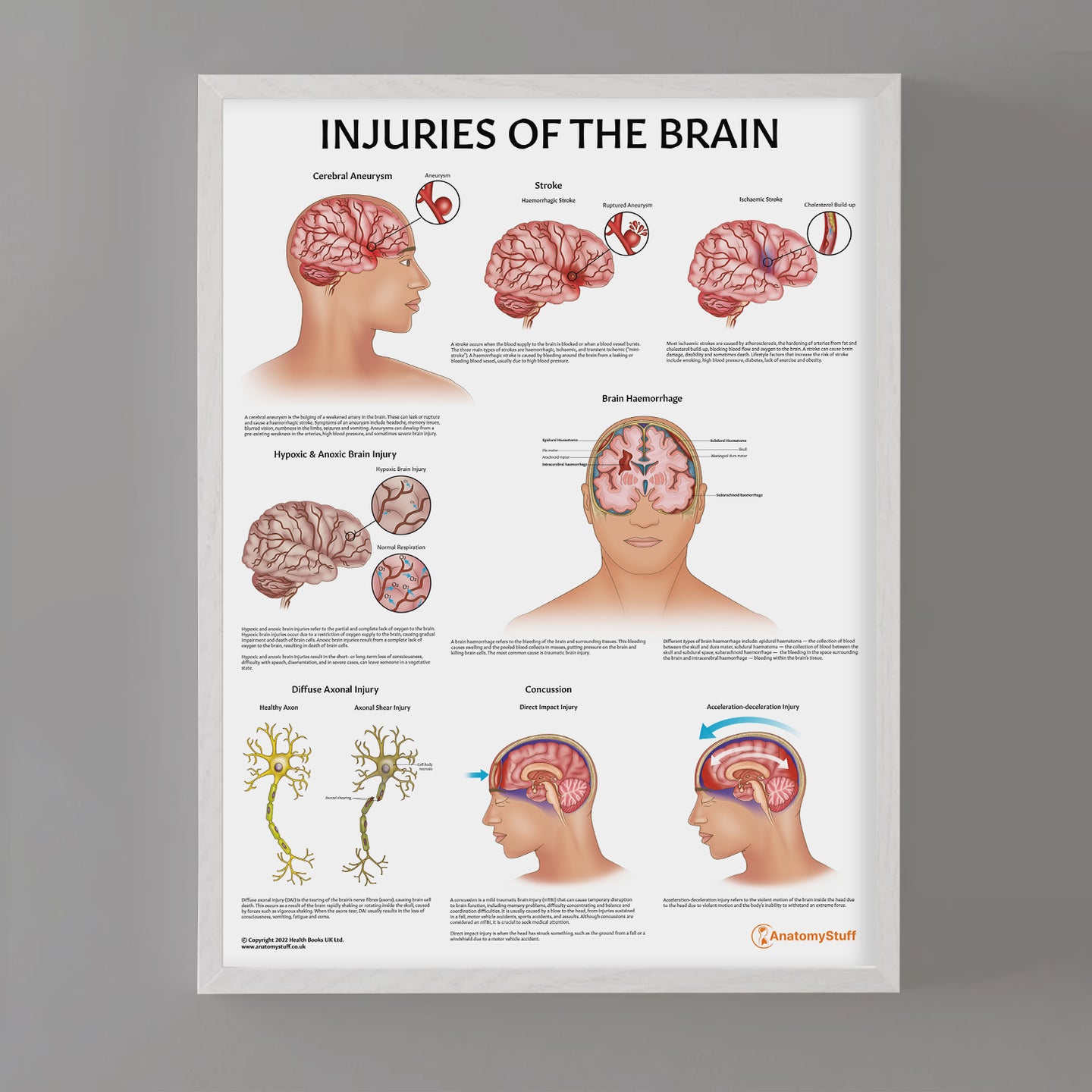 Injuries of the Brain Poster | Brain Trauma Anatomy Chart – AnatomyStuff