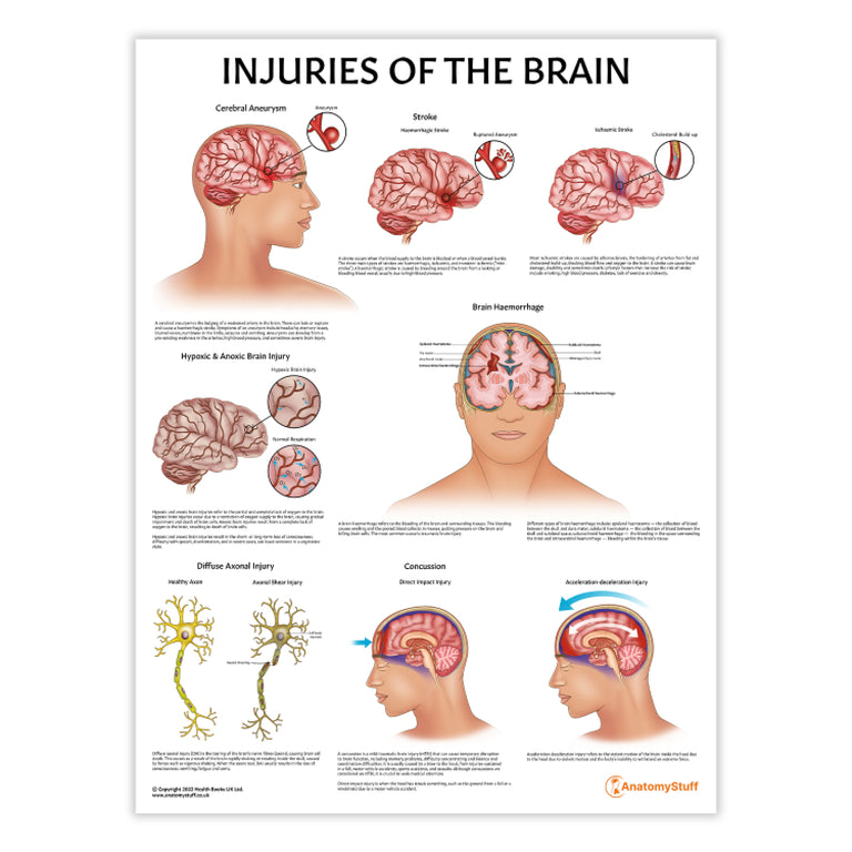 Injuries of the Brain Poster | Brain Trauma Anatomy Chart – AnatomyStuff