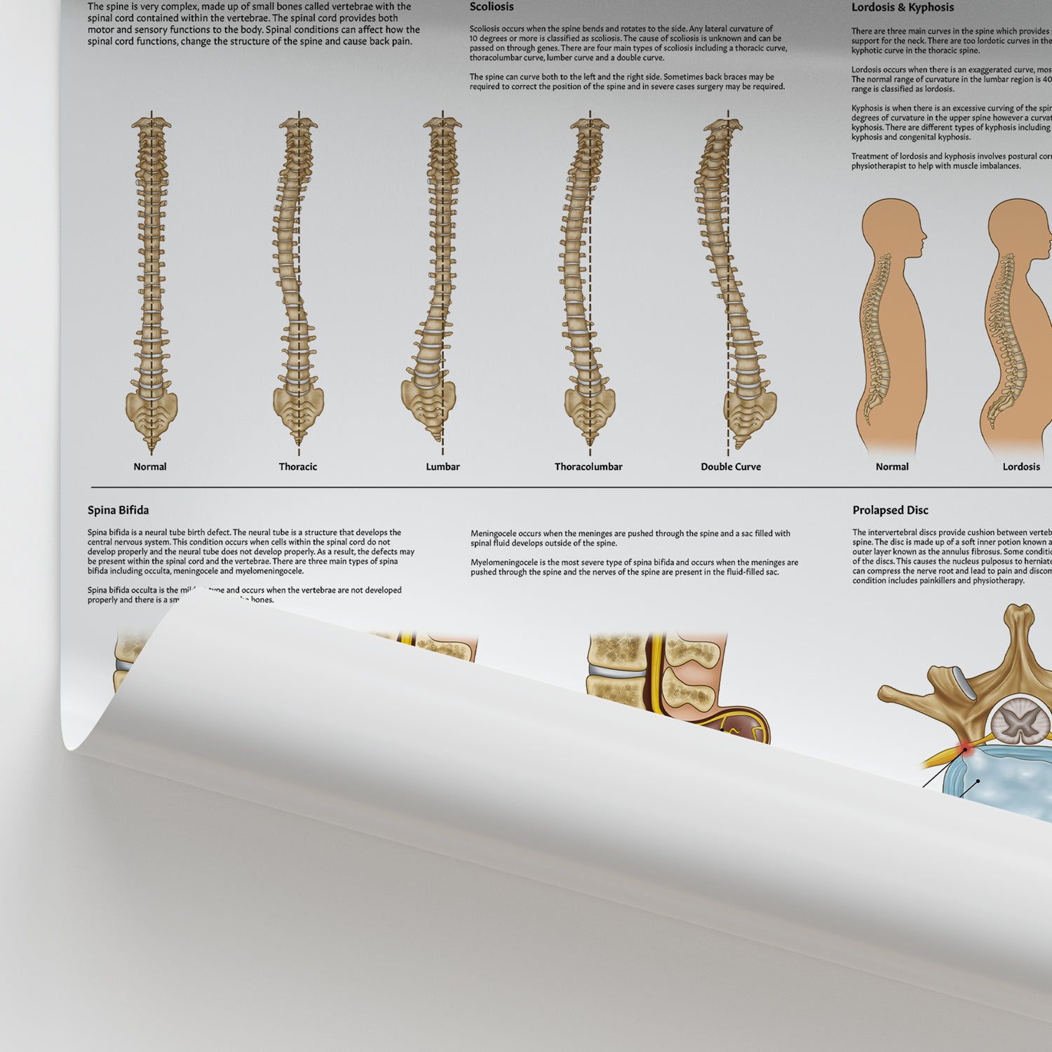 Back Conditions Examples Spinal Conditions Poster | Spine Pathology Educational Chart โ AnatomyStuff