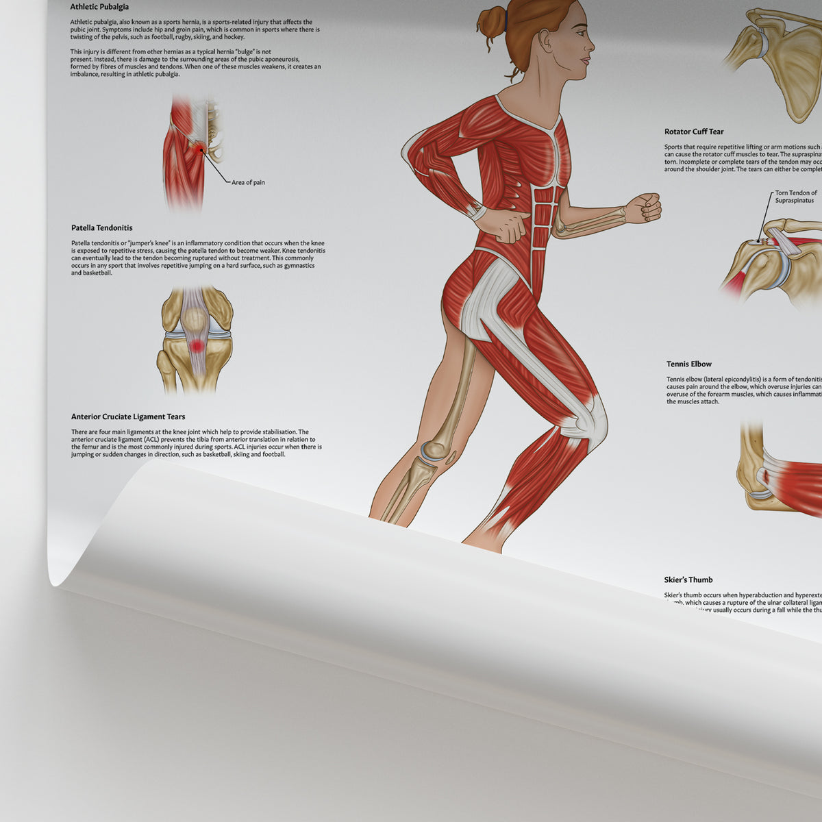 Injuries Stratch Sports Injuries Chart | Fracture, Sprain, Dislocation & Tear Poster ...