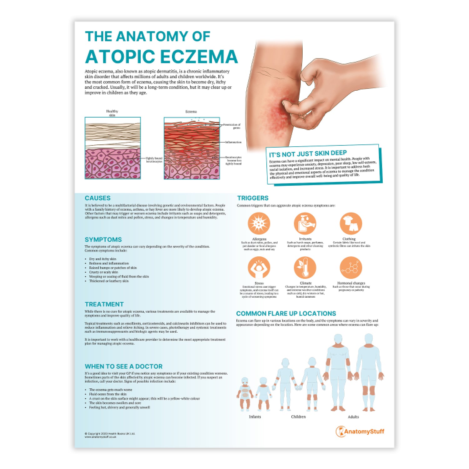 The Anatomy of Atopic Eczema Chart | Dermatology Poster – AnatomyStuff