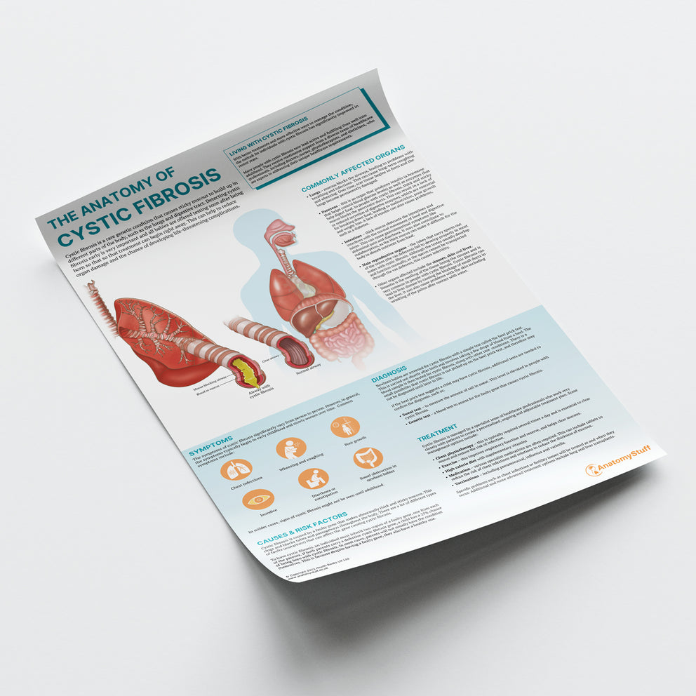 The Anatomy of Cystic Fibrosis Chart | Respiratory Health Poster ...