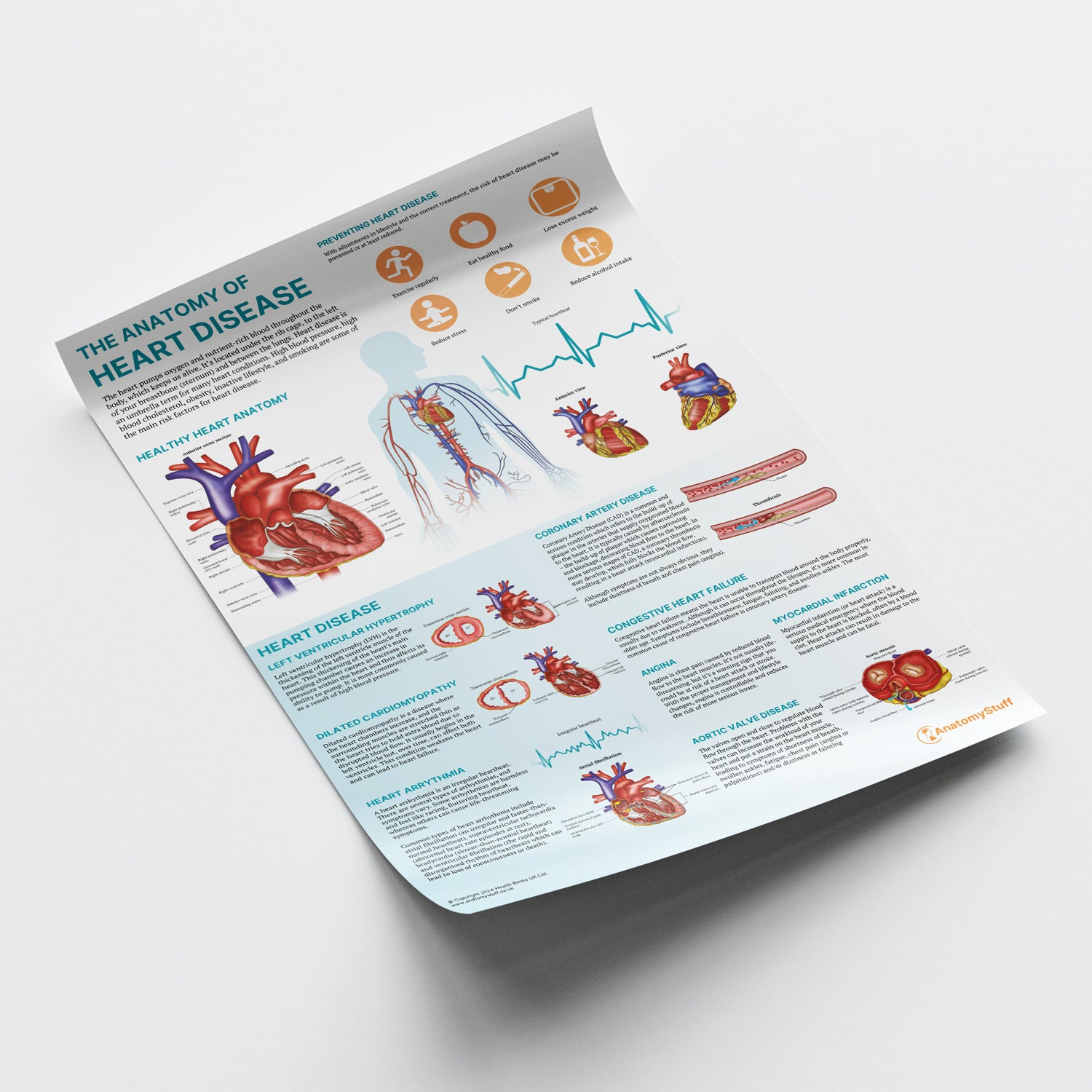 Heart Problem Chart Anatomy of Heart Disease Poster | Cardiovascular Conditions Chart ...