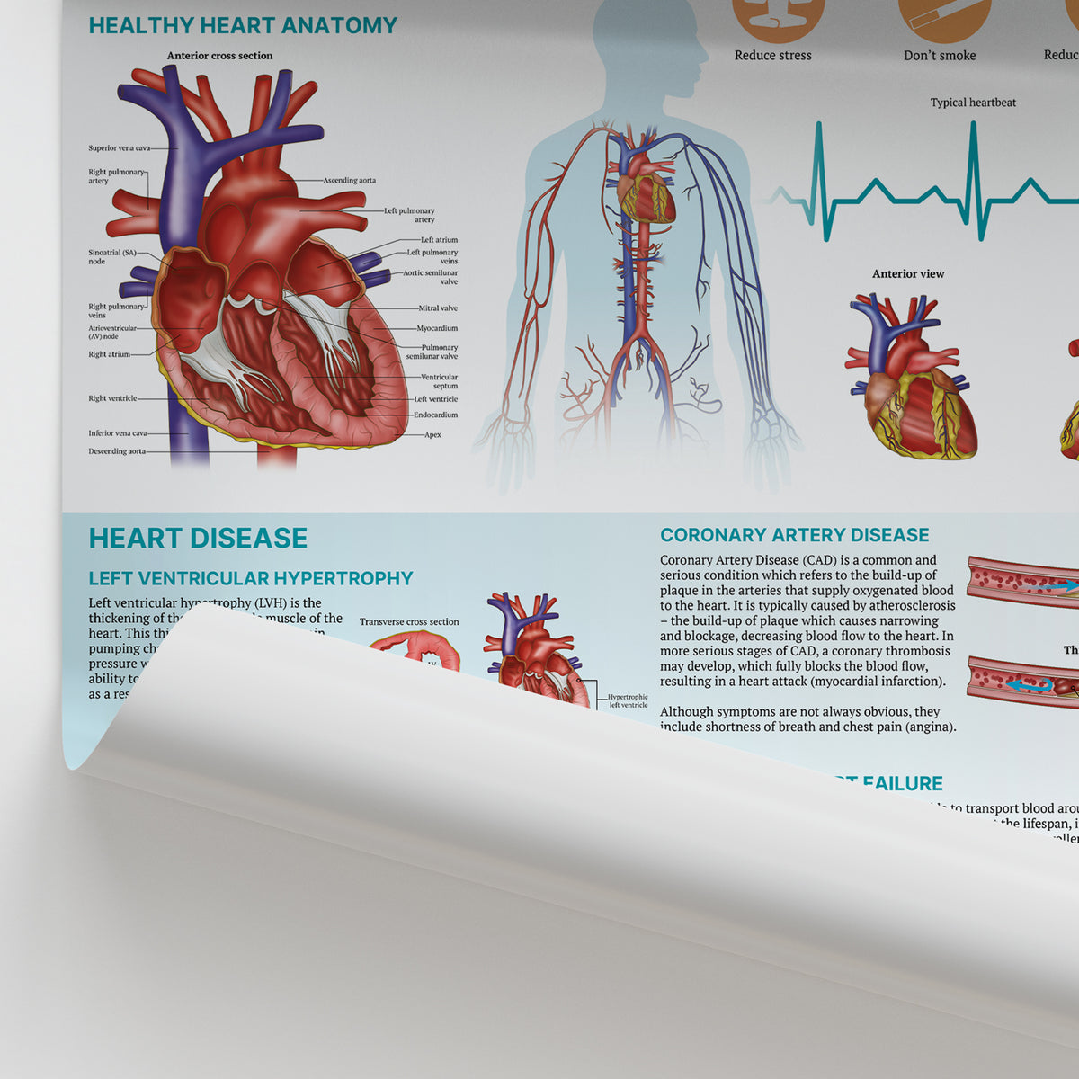 Heart Problem Chart Anatomy of Heart Disease Poster | Cardiovascular Conditions Chart ...