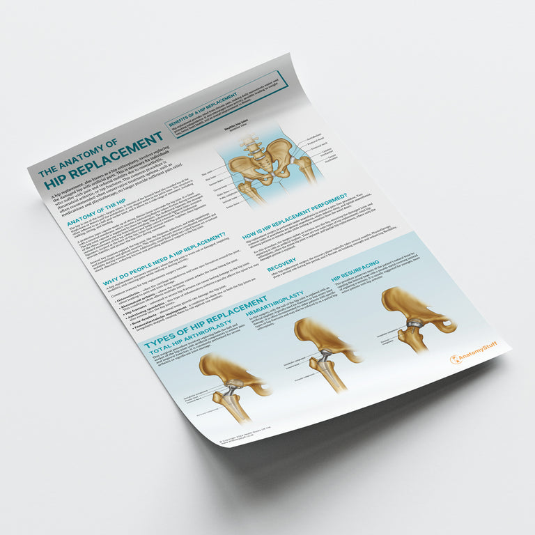 Hip Replacement Anatomy Poster | Surgical Procedure & Recovery Chart ...