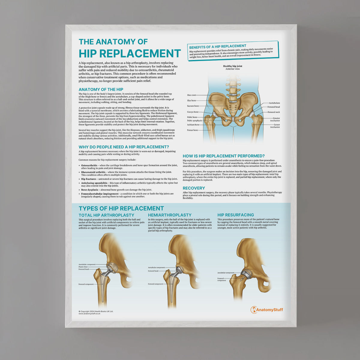 Hip Replacement Anatomy Poster | Surgical Procedure & Recovery Chart ...