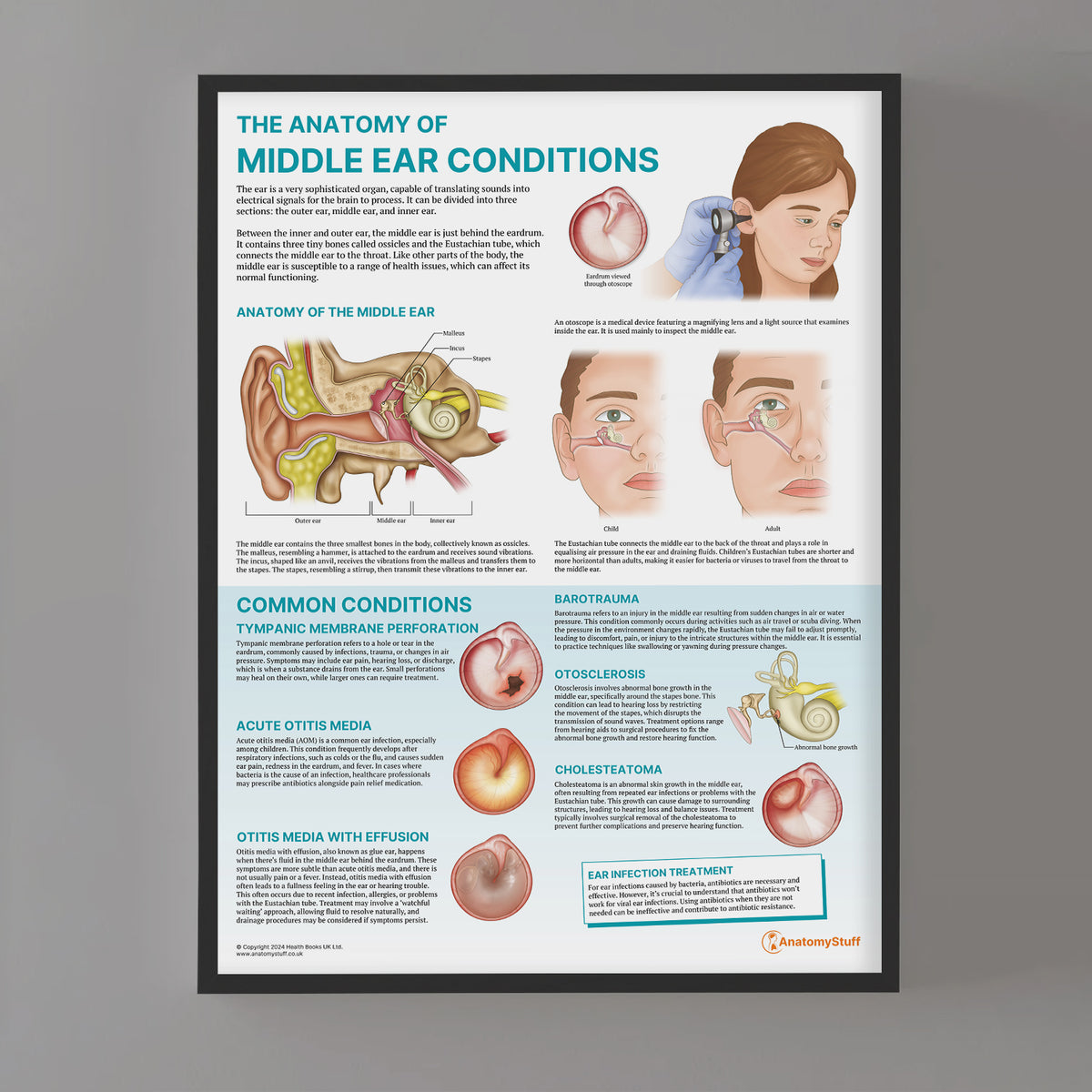 Middle Ear Pathologies The Anatomy of Middle Ear Conditions Poster | ENT Education – AnatomyStuff