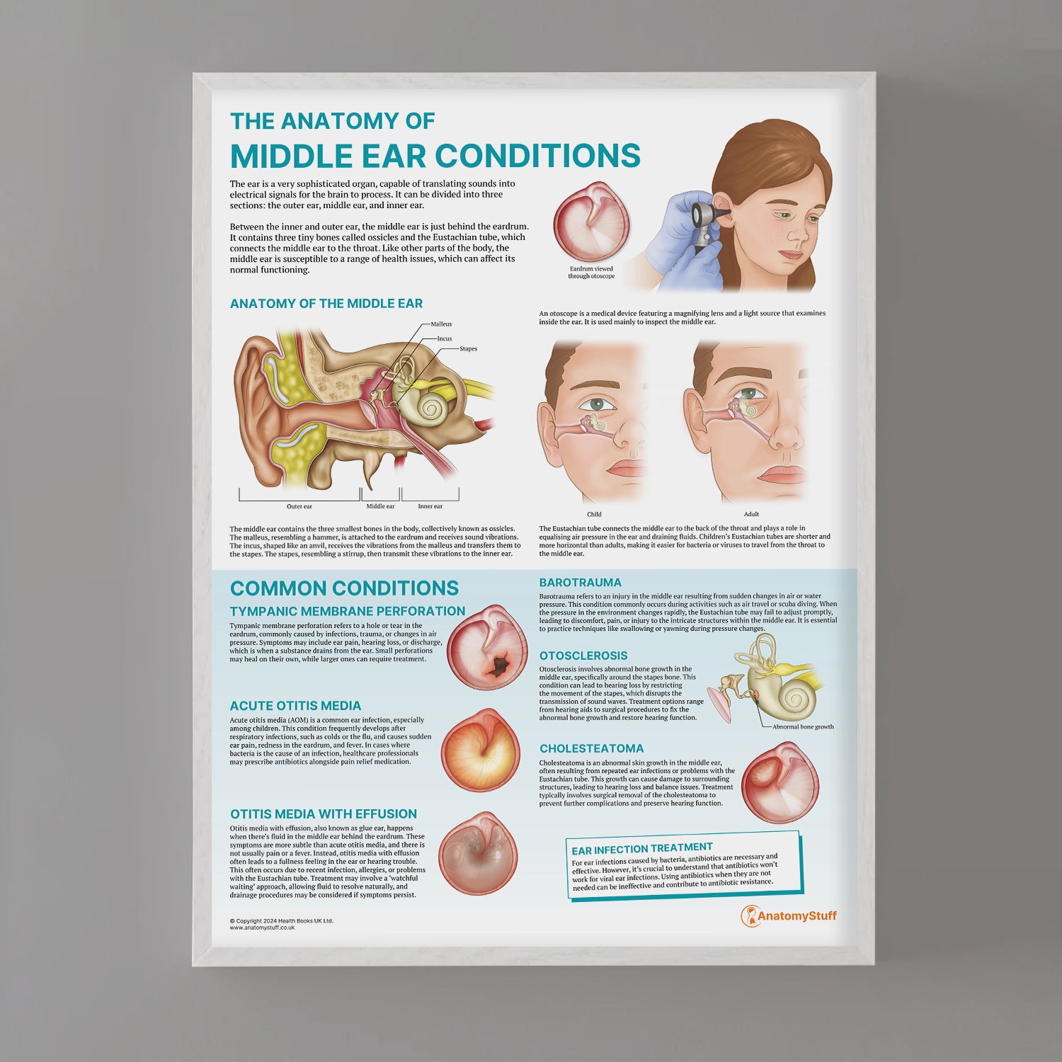 Mid Ear Loop The Anatomy of Middle Ear Conditions Poster | ENT Education – AnatomyStuff