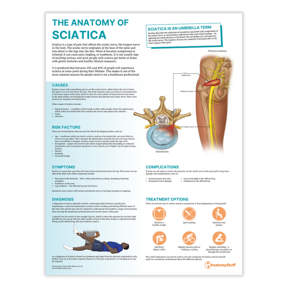 The Anatomy of Sciatica Chart / Poster