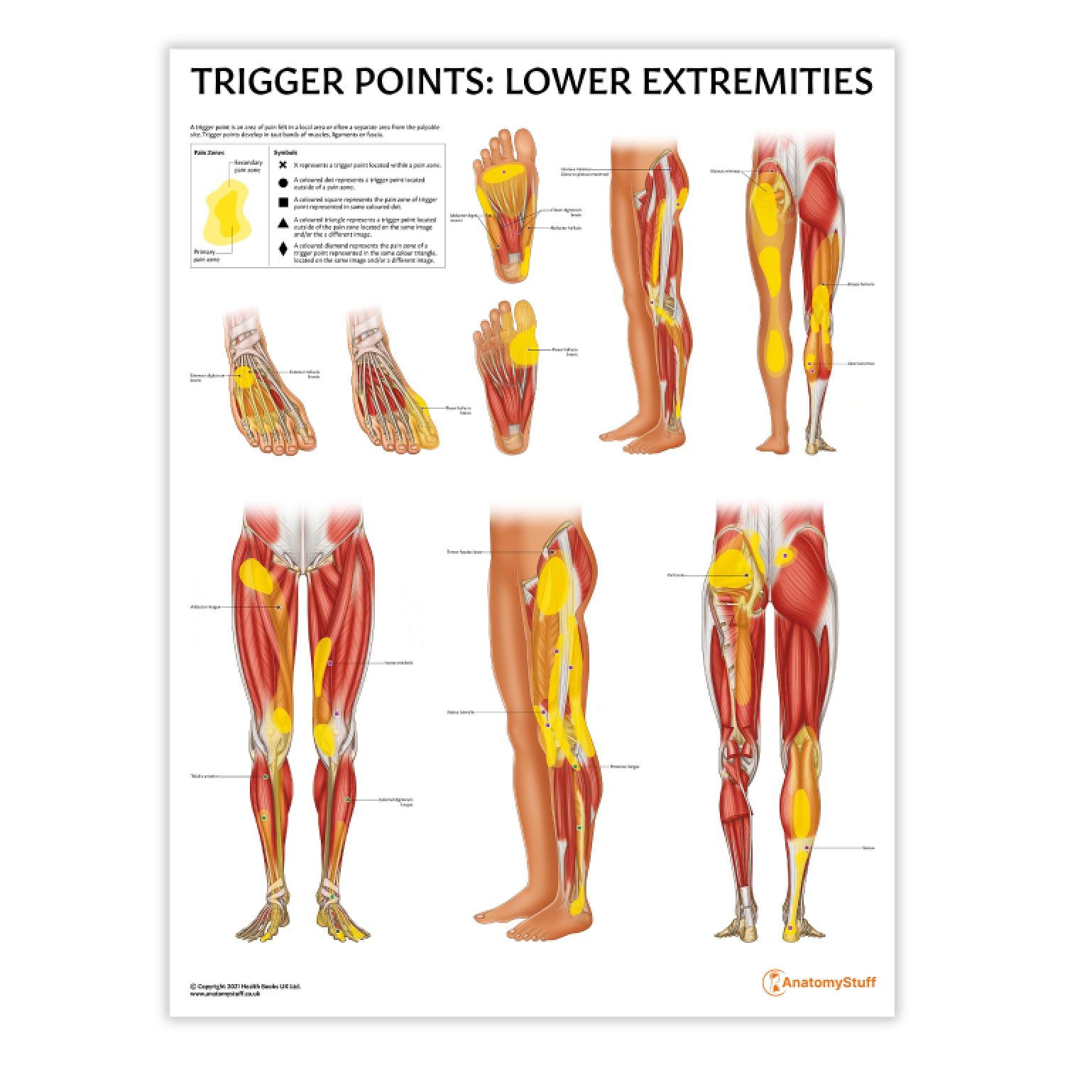 Trigger Points: Lower Extremities Poster | Hip, Knee, Foot Pain Chart ...